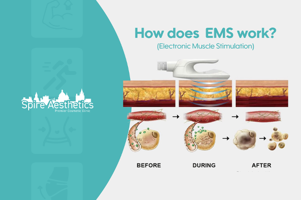 EMS treatment for post pregnancy weight loss treatment Dumbarton