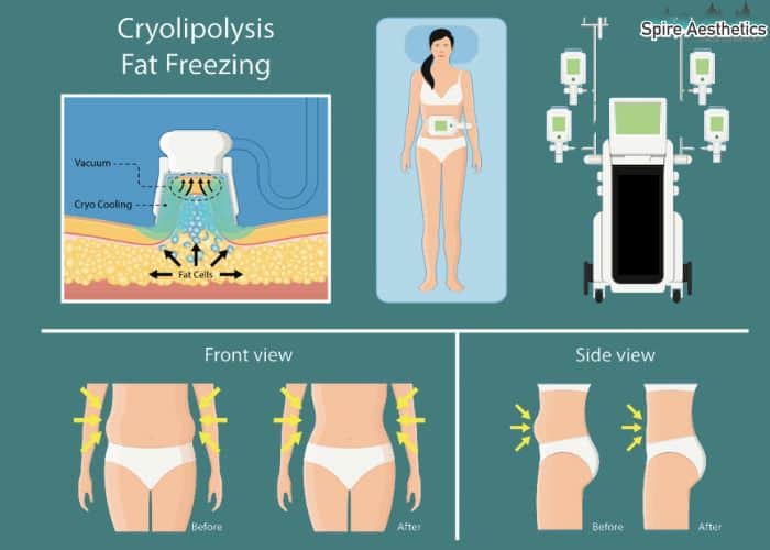 Image of diet and fat freezing combined for best results for Spire Aesthetics Dumbarton