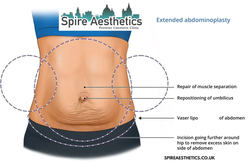 Understanding Loose Skin After Gastric Band Dumbarton Surgery and HIFU Treatment