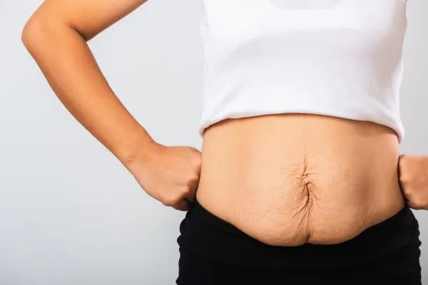 Image of a woman's stomach after weight loss with sagging skin following a gastric band Dumbarton