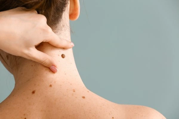 skin blemish removal Dumbarton treatment
