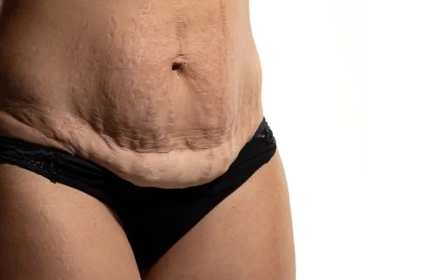 Image of womans stomach after weight loss injections Dumbarton showing saggy skin