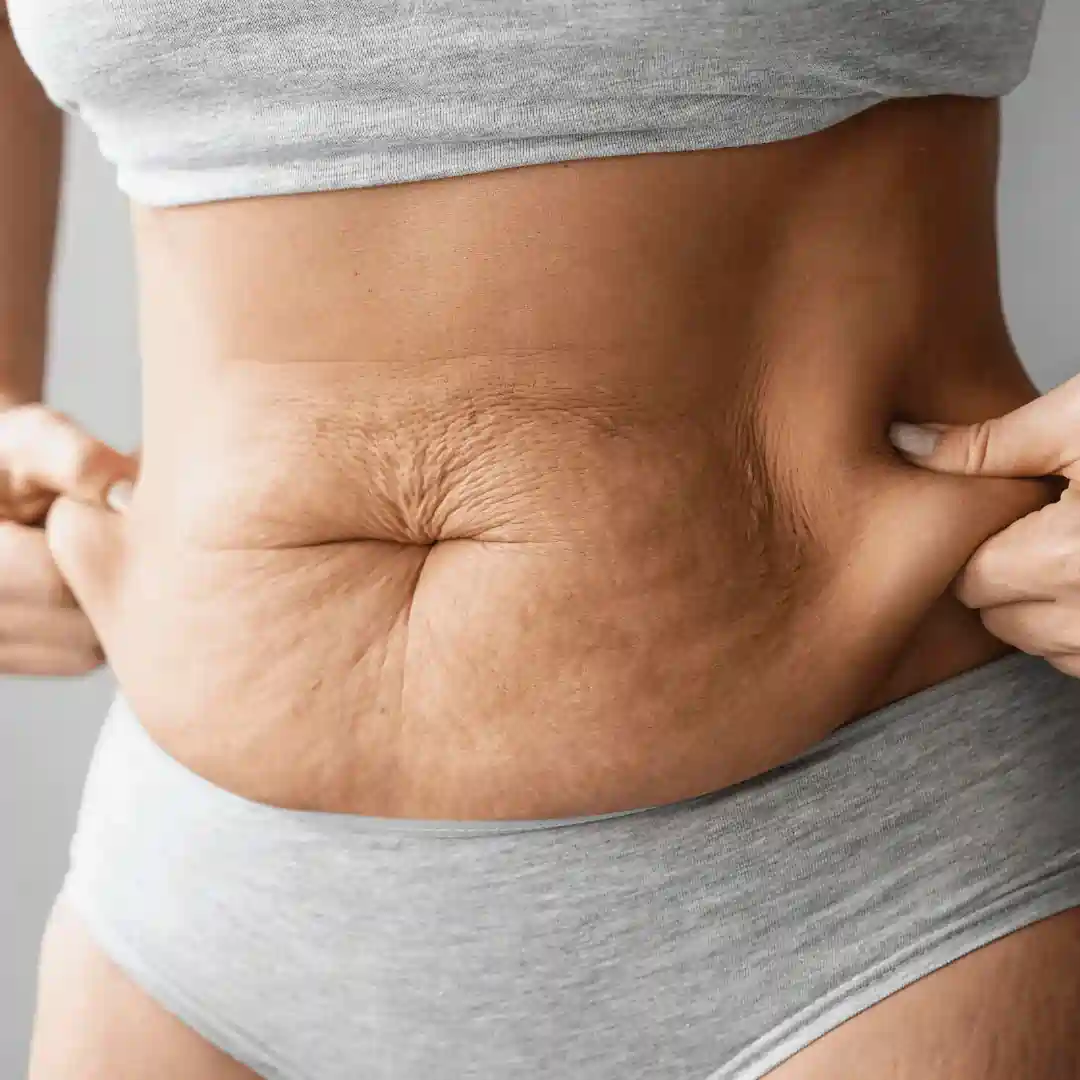 Is It Normal to Have Loose Skin After Pregnancy Dumbarton?